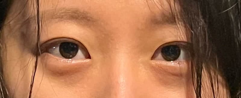 올영 컨실러 다 사본 사람이 쓰는 ㅇㅂㅈ 김현조 원장님 눈밑지 후기 1