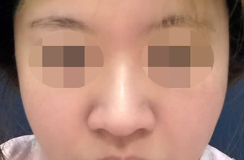 복코 탈출하고 자련코 된 두달차 후기 ㅇㅂㅈ 이경묵원장님 1