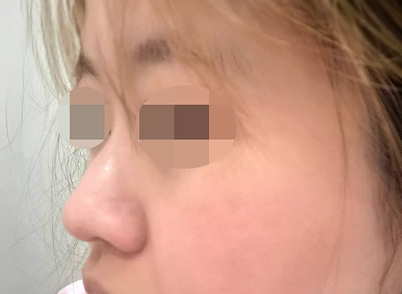복코 탈출하고 자련코 된 두달차 후기 ㅇㅂㅈ 이경묵원장님 2