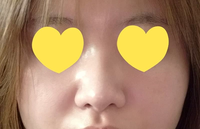 복코 탈출하고 자련코 된 두달차 후기 ㅇㅂㅈ 이경묵원장님 3
