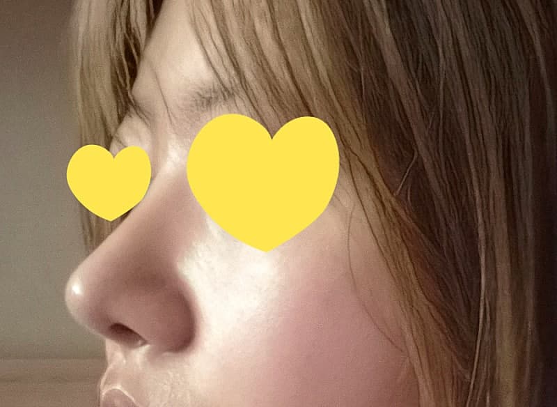 복코 탈출하고 자련코 된 두달차 후기 ㅇㅂㅈ 이경묵원장님 5