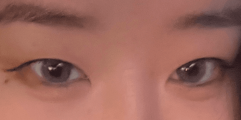 강남쌍수 재수술 절개 후기 가져왔어요 1