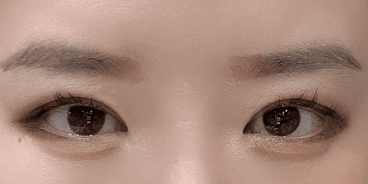 강남쌍수 재수술 절개 후기 가져왔어요 2
