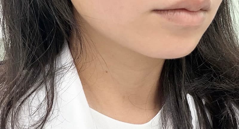 구월동 올타이트리프팅 후기, 생각보다 만족스러웠던 리프팅 시술 11