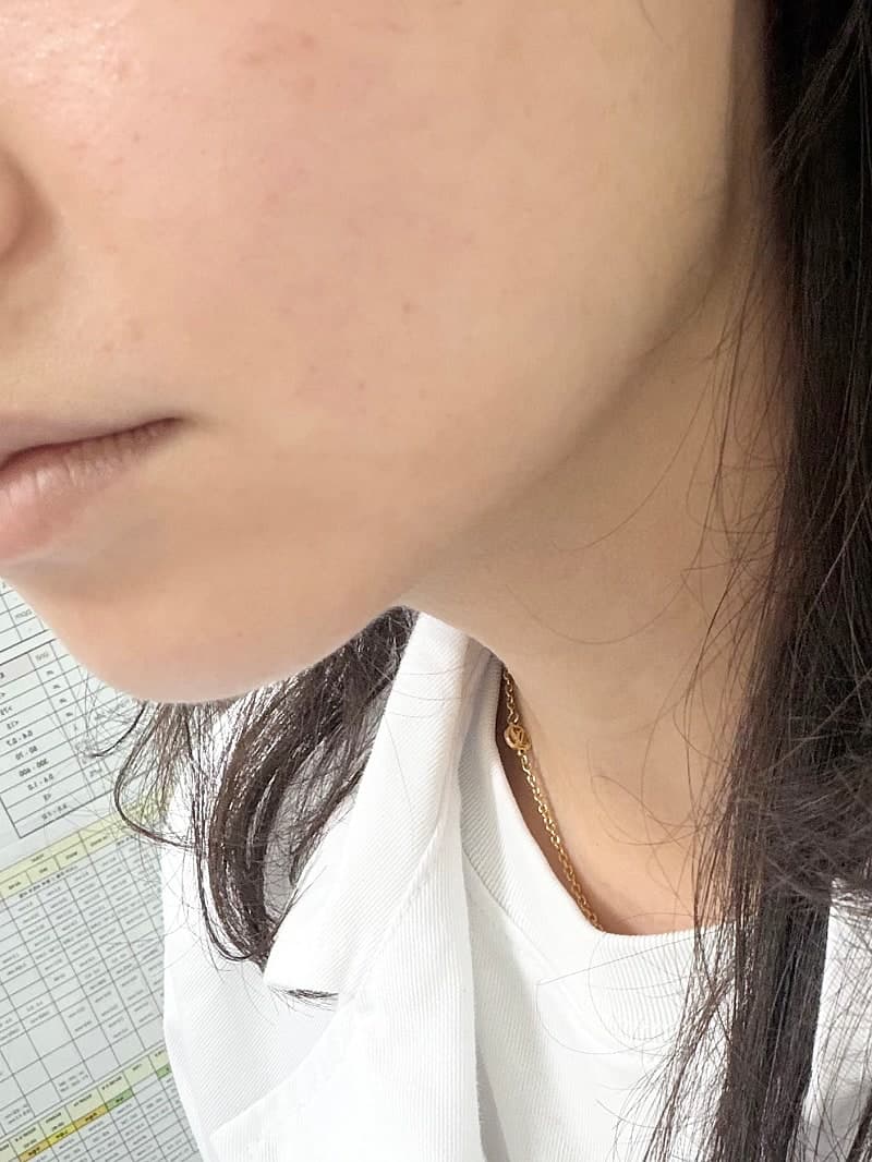구월동 올타이트리프팅 후기, 생각보다 만족스러웠던 리프팅 시술 13