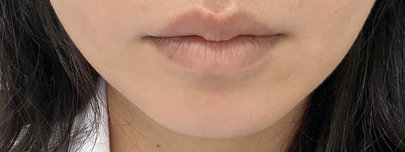 구월동 올타이트리프팅 후기, 생각보다 만족스러웠던 리프팅 시술 15