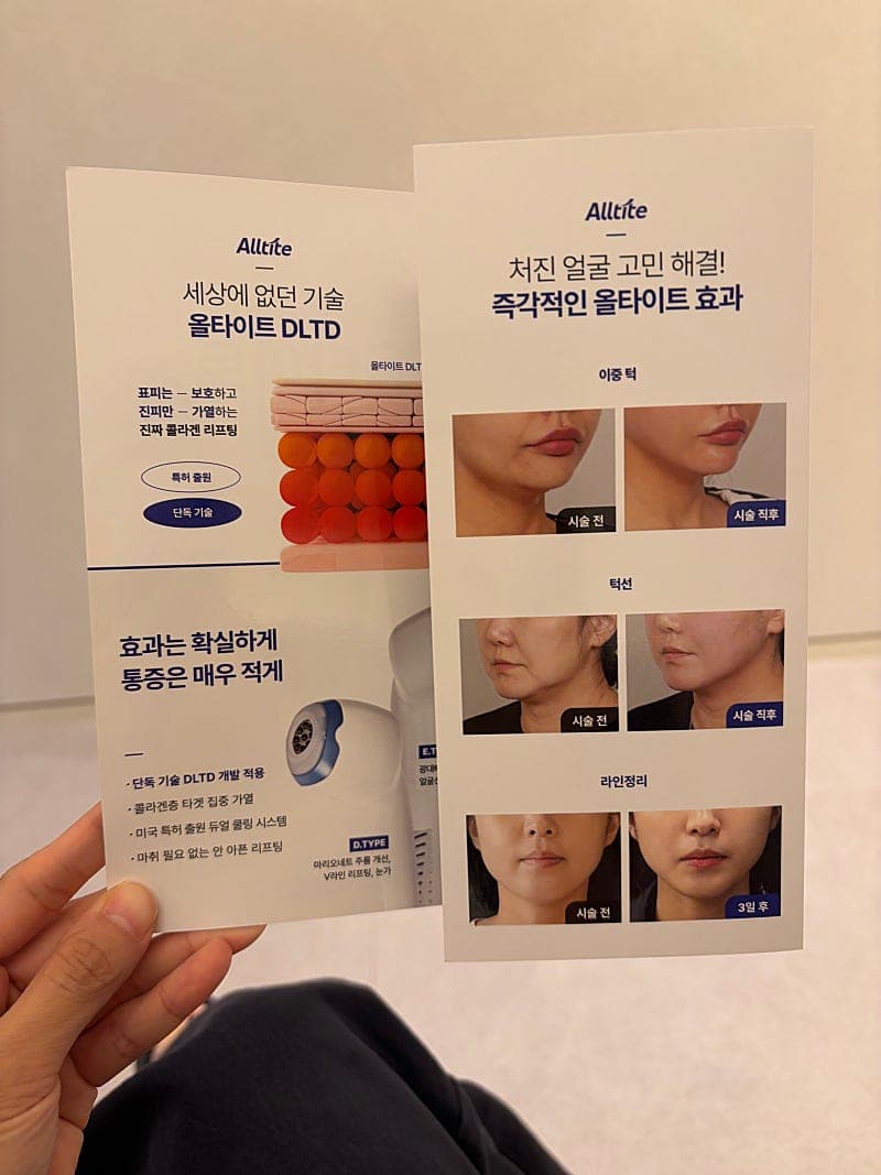 구월동 올타이트리프팅 후기, 생각보다 만족스러웠던 리프팅 시술 4