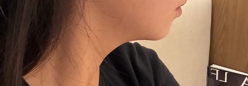 구월동 올타이트리프팅 후기, 생각보다 만족스러웠던 리프팅 시술 5