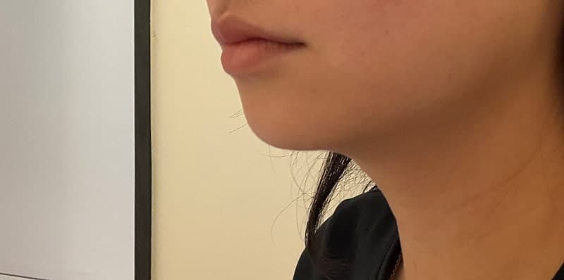 구월동 올타이트리프팅 후기, 생각보다 만족스러웠던 리프팅 시술 6
