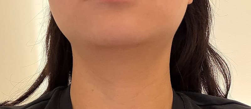 구월동 올타이트리프팅 후기, 생각보다 만족스러웠던 리프팅 시술 7