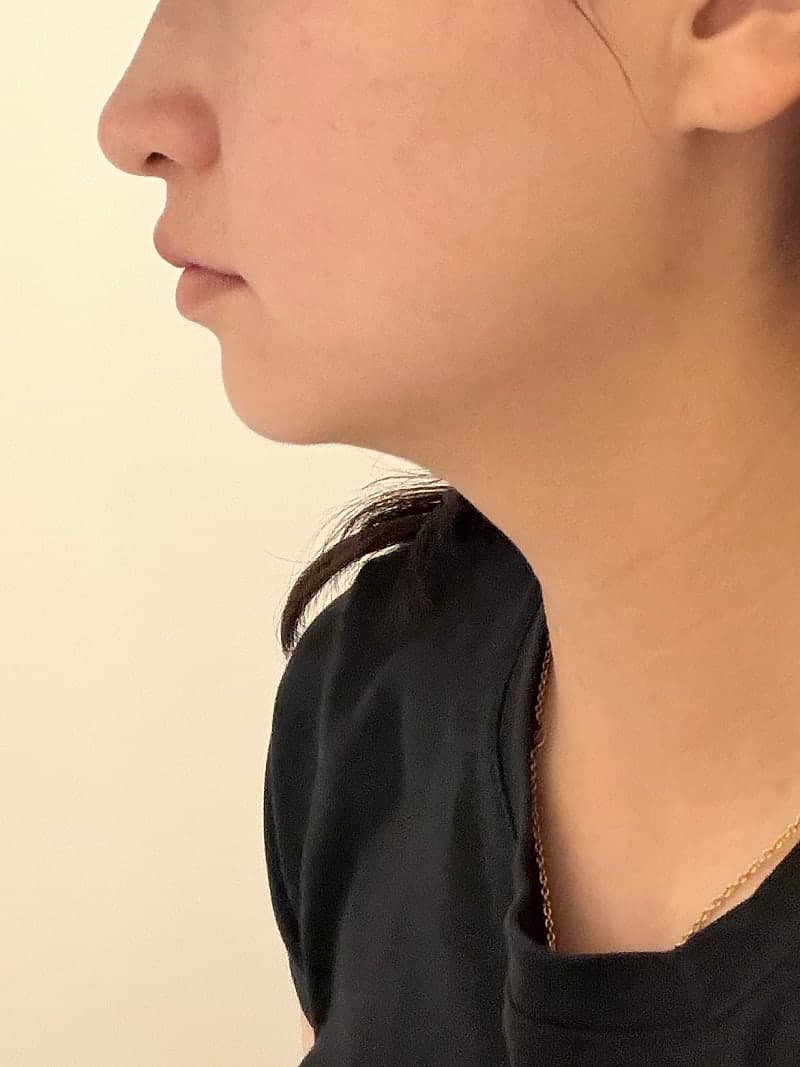 구월동 올타이트리프팅 후기, 생각보다 만족스러웠던 리프팅 시술 8