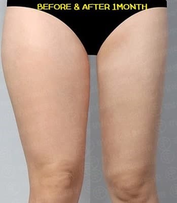 허벅지안쪽지방흡입 수술 후기 한달차 공유! 1