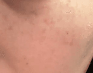 청주피코토닝 잘하는 곳 찾는 중인데,,ㅠ 1