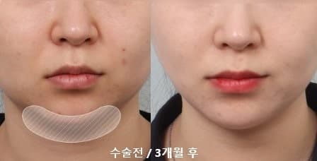 심부볼지방제거 받은 후기에요 1