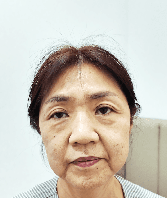 하안검이랑 안면거상 같이 했는데 후회없어요 1