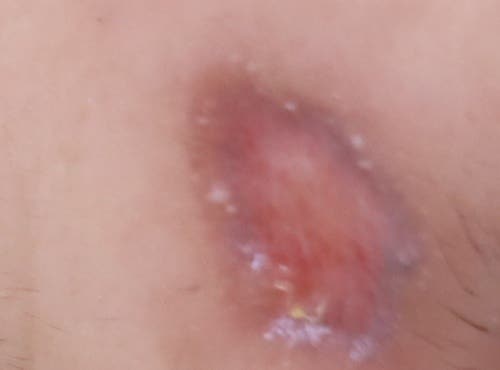 얼굴대상포진 흉터 노원역피부과 새살침 후기 1