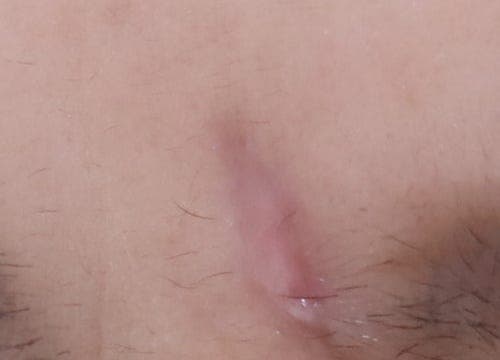 얼굴대상포진 흉터 노원역피부과 새살침 후기 2