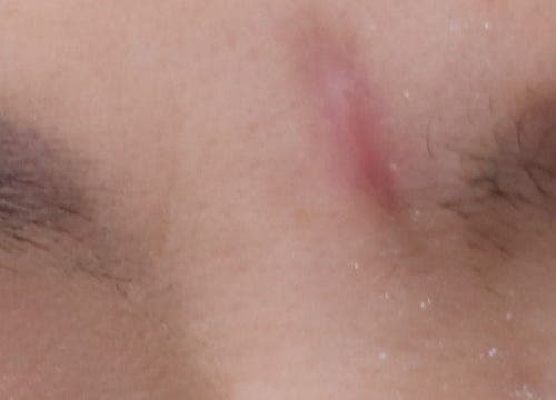 얼굴대상포진 흉터 노원역피부과 새살침 후기 3