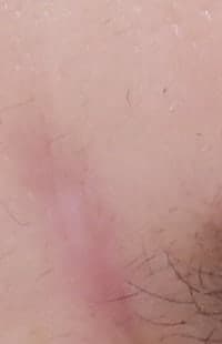 얼굴대상포진 흉터 노원역피부과 새살침 후기 4
