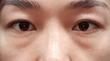 눈밑지방재배치수술 비용 40만대로 가능하네요! 1