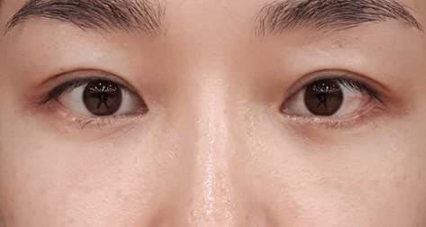 눈밑지방재배치수술 비용 40만대로 가능하네요! 2