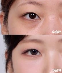 눈밑지방재배치레이저 수술가격 70마넌? 1