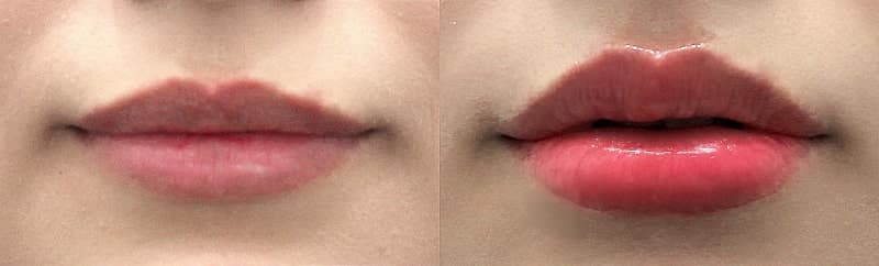 명동 입술필러 저 체리입술 됬는데 어떄욤?(사진있음) 1