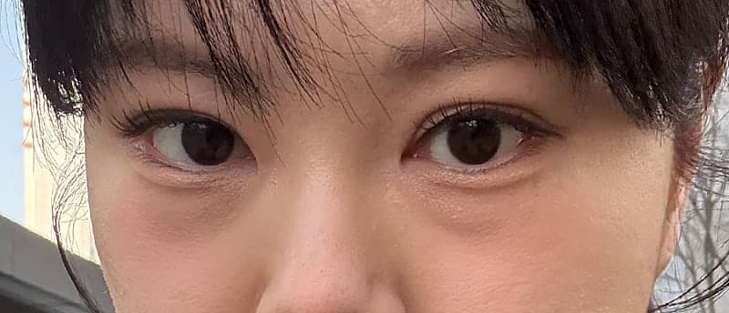 인아웃 맛집 찾으시면 오브제요ㅠㅠ 박시현 원장님 쌍꺼풀재수술 후기!! 1