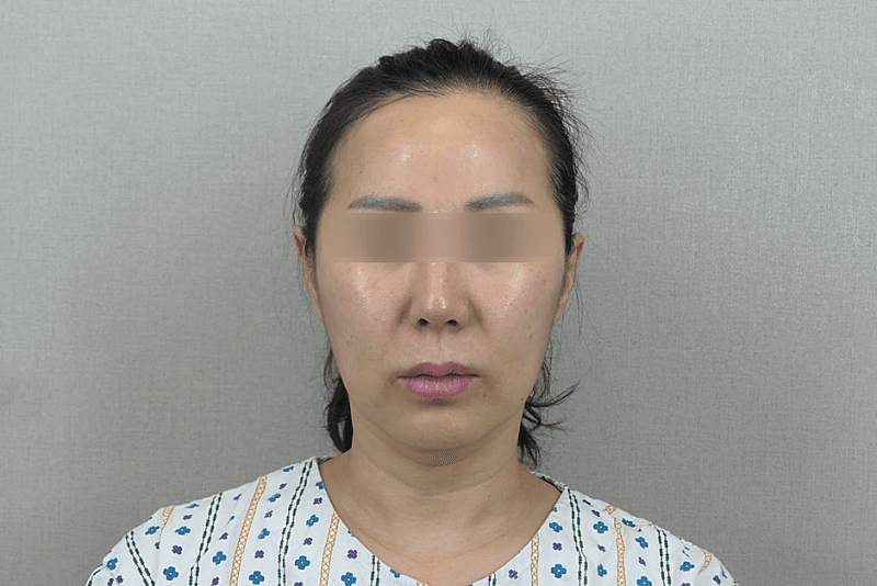 리프팅 하고 인상이 덜 피곤해보여요 1