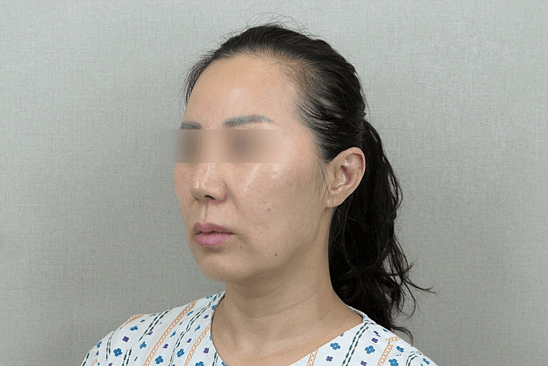 리프팅 하고 인상이 덜 피곤해보여요 2