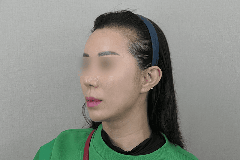 리프팅 하고 인상이 덜 피곤해보여요 4