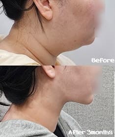 얼굴지방흡입 이중턱 뿌순 비용 후기! 1
