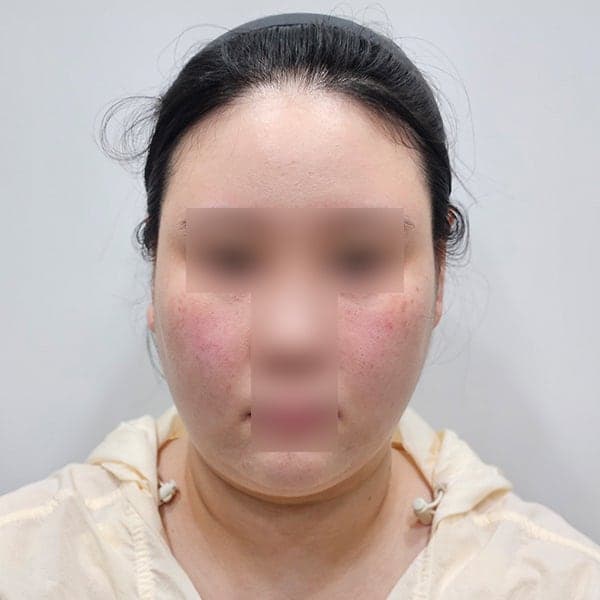 얼굴지방흡입 이중턱 뿌순 비용 후기! 2