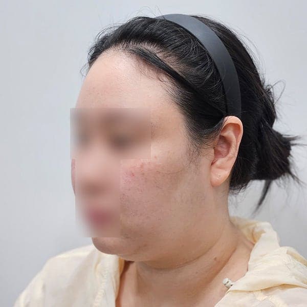 얼굴지방흡입 이중턱 뿌순 비용 후기! 3