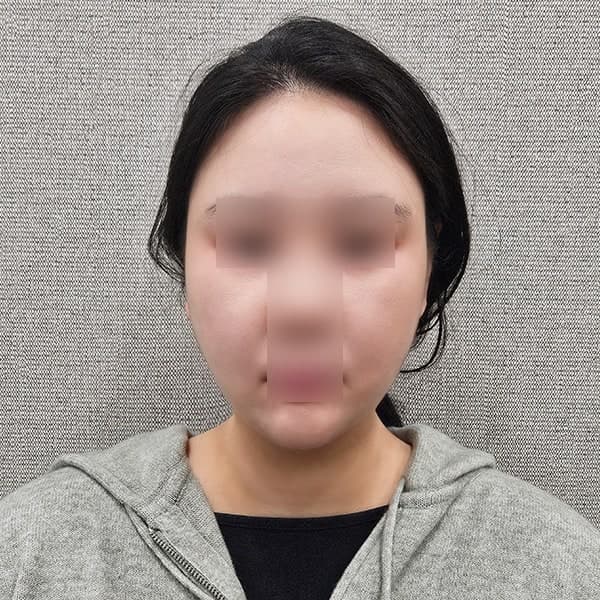 얼굴지방흡입 이중턱 뿌순 비용 후기! 4