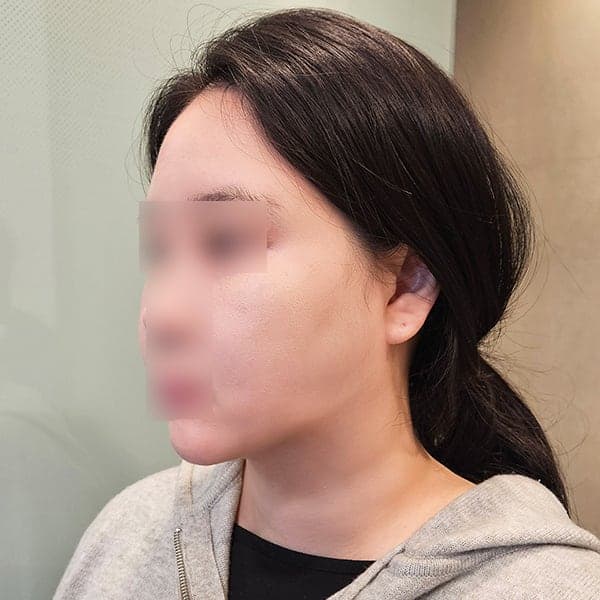 얼굴지방흡입 이중턱 뿌순 비용 후기! 5