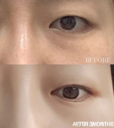 상안검수술비용 눈꺼풀처짐 70마넌에 개선함 1