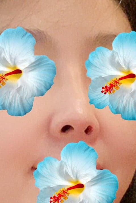 코수술 다시 했다 (코끝재수술) 1