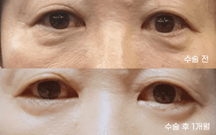 상안검하안검 상하안검수술 후기 70마넌에가능 1