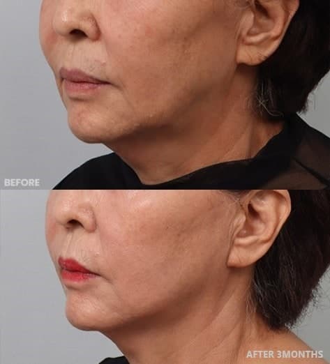 안면거상가격 미니리프팅비용 전후 50만원대에가능 1