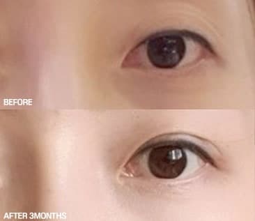 눈썹거상술 후기 3달차전후 70만에가능 1