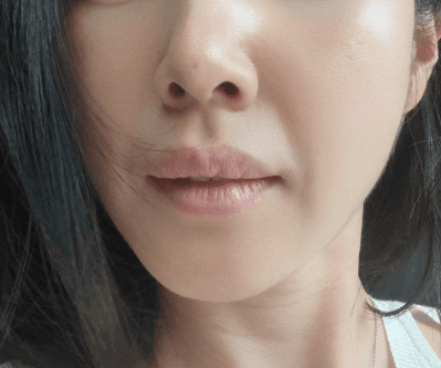 팔자주름 쥬베룩볼륨 효과 비용 다 공유할게요 1