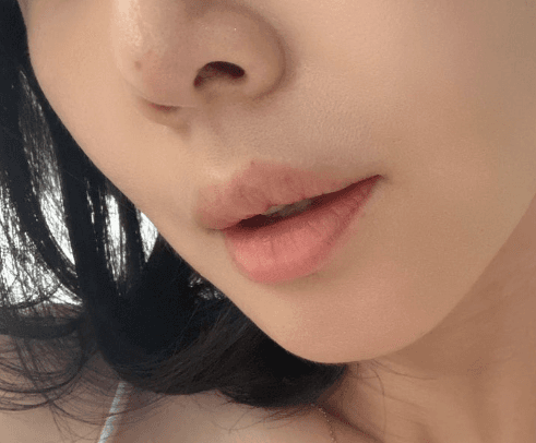 팔자주름 쥬베룩볼륨 효과 비용 다 공유할게요 2