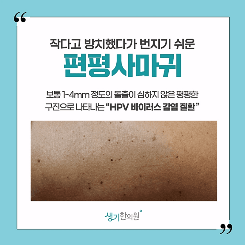편평사마귀 흉터 걱정 없는 정밀 치료로 관리해보세요! 2