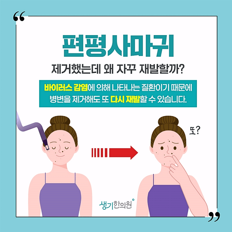 편평사마귀 흉터 걱정 없는 정밀 치료로 관리해보세요! 4