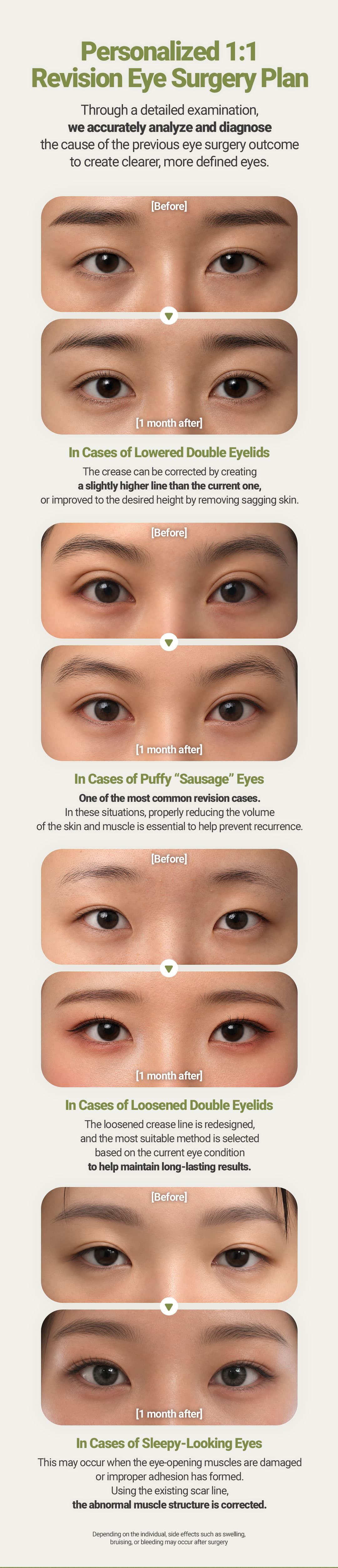 (Non Incision) Revision Double eyelid Surgery 2