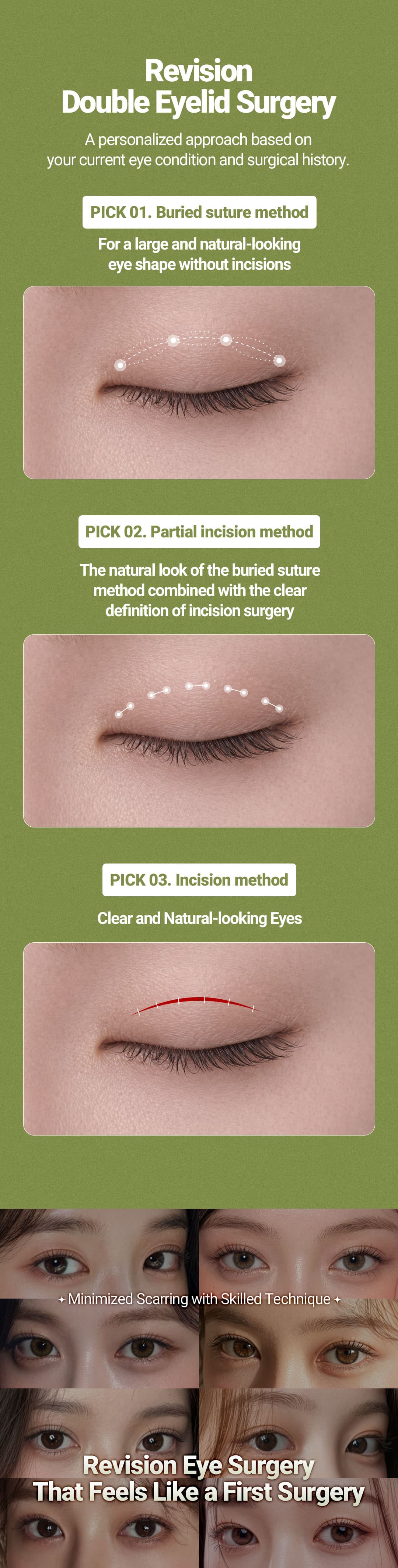 (Non Incision) Revision Double eyelid Surgery 1