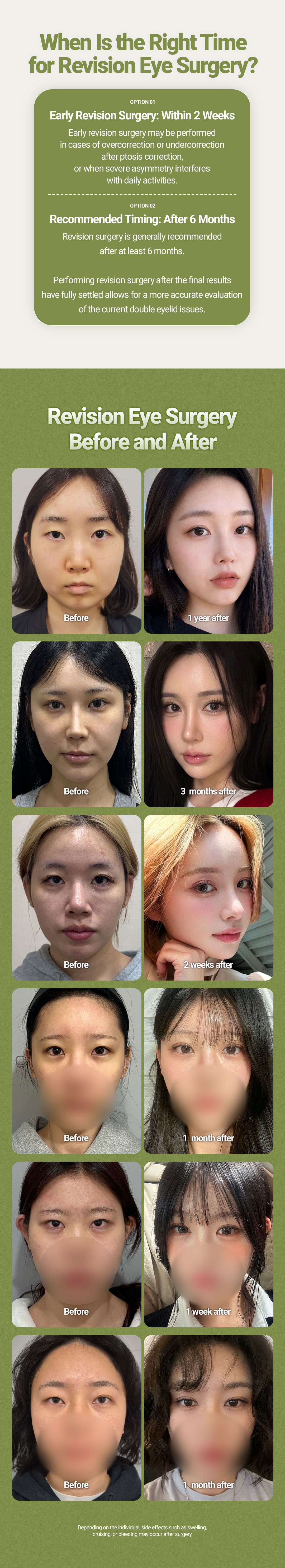 (Non Incision) Revision Double eyelid Surgery 6