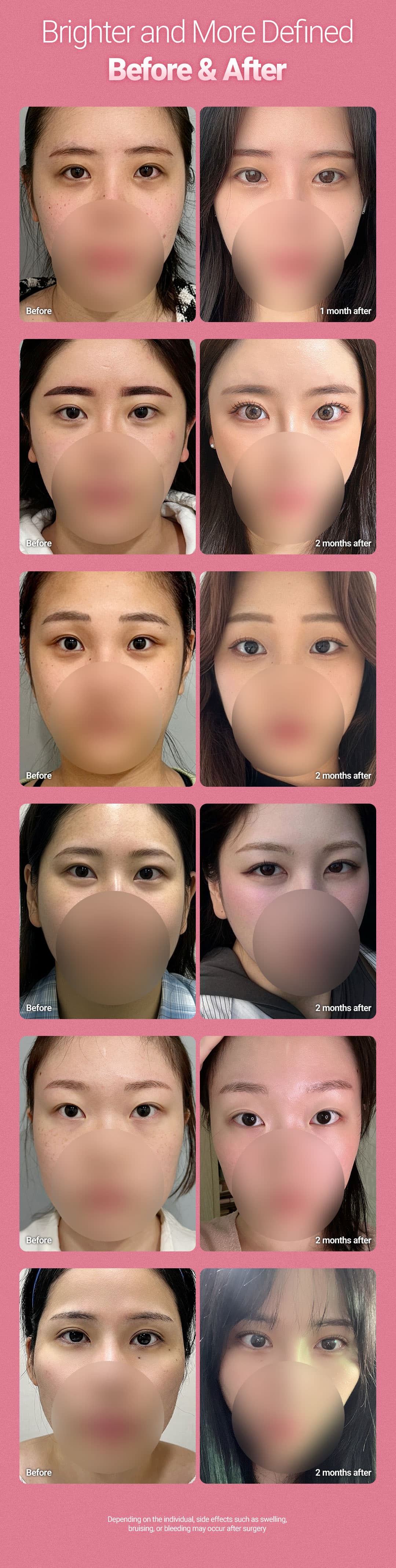 Eye Enlargement 4