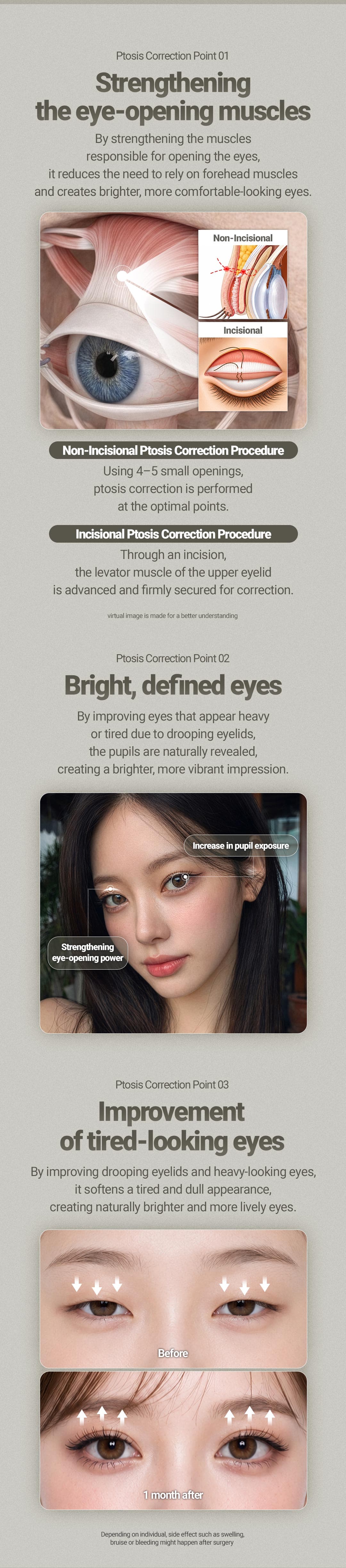Koreksi Ptosis Mata (Tanpa Sayatan) 2
